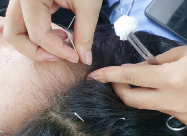  TRỊ LIỆU RỐI LOẠN TIỀN ĐÌNH – GIẢM CHÓNG MẶT, MẤT NGỦ, CĂNG THẲNG