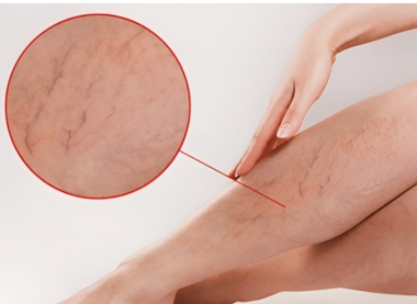 TRỊ LIỆU SUY GIÃN TĨNH MẠCH – GIẢM SƯNG PHÙ, ĐAU NHỨC, TÁI TẠO TUẦN HOÀN MÁU