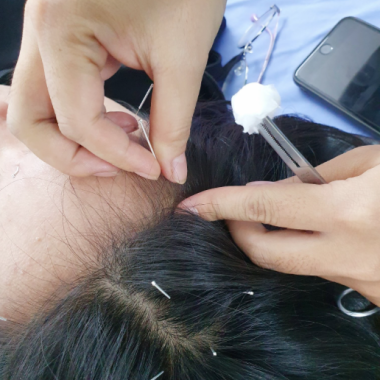  TRỊ LIỆU RỐI LOẠN TIỀN ĐÌNH – GIẢM CHÓNG MẶT, MẤT NGỦ, CĂNG THẲNG