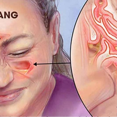 ĐIỀU TRỊ VIÊM XOANG MÃN TÍNH THEO PHƯƠNG PHÁP Y HỌC VIỆT & PHẢN CHIẾU VI CƠ THỂ
